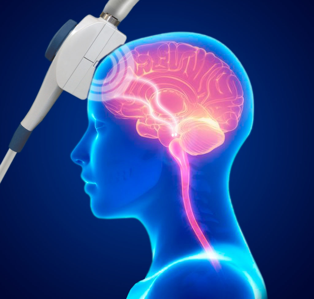 transcranial-magnetic-stimulation-Suchigo-blog-1024x974.jpg