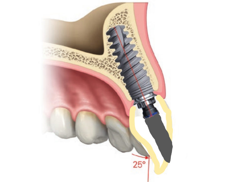 種植體斜著  開孔0°.png